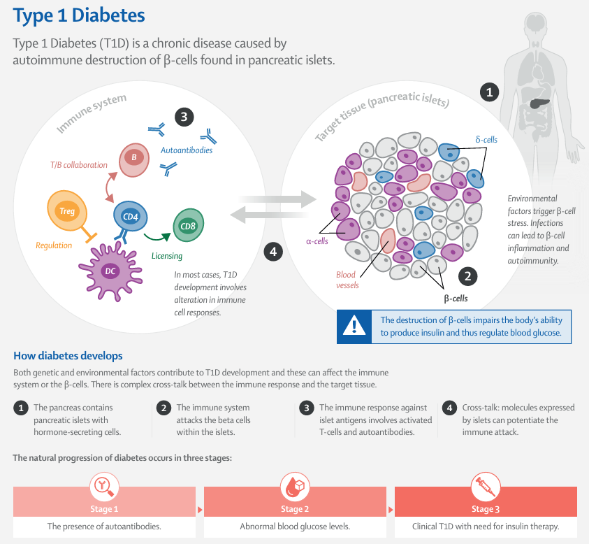Type 1 diabetes is a chronic disease, where individuals are reliant on insulin for survival.

A Seminar reviews the field of type 1 diabetes, highlighting recent progress, challenges to clinical care, and future directions in research: hubs.li/Q02LpqNz0