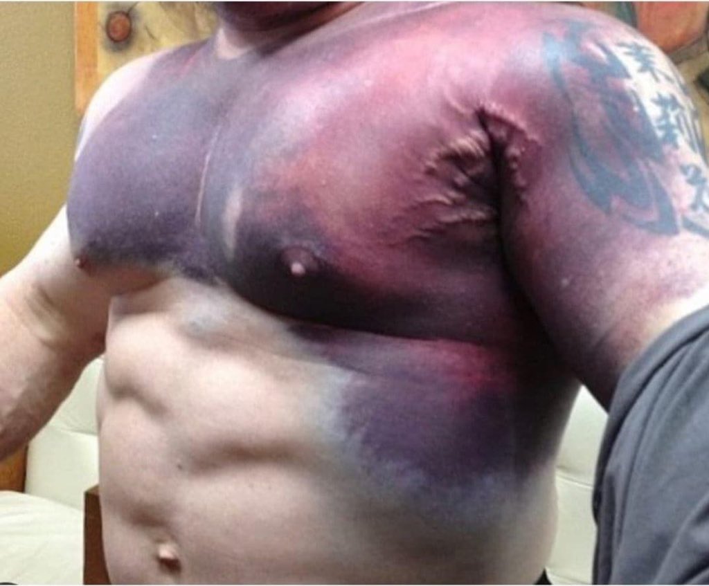 hemo_shk's tweet photo. Patient presents today to the emergency room from the gym, after excessive weight lifting. 
Physical exams shows this. 

What is your diagnosis?

#MedEd #MEDHM #MedTwitter #MedX @IhabFathiSulima https://t.co/QALSVC5Drk
