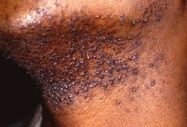 healthprefectt's tweet photo. 🚨 Razor Bumps: Causes, Prevention, and Treatment

Razor bumps, also known as pseudofolliculitis barbae, are a common skin condition that occurs after shaving.  Razor bumps are more common in people with curly or coarse hair but can affect anyone who shaves.

A thread 👇 https://t.co/y3GhMokpDh