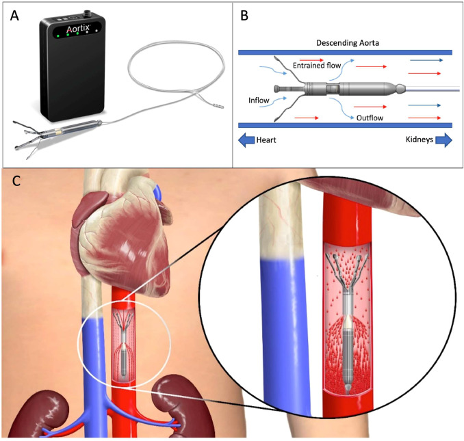 Marat Fudim, MD MHS (@fudimmarat) on Twitter photo Today is a good day to Prevent or Drain➡️Heart Failure:
1. Left Ventricular Unloading Using Intra-Aortic Entrainment Pumping Before Reperfusion Reduces Post-AMI Infarct Size <a href="/JCardFail/">Journal of Cardiac Failure</a> onlinejcf.com/article/S1071-…
#3 Main findings from new pre-clinical study ⬇️ Today is a good day to Prevent or Drain➡️Heart Failure:
1. Left Ventricular Unloading Using Intra-Aortic Entrainment Pumping Before Reperfusion Reduces Post-AMI Infarct Size <a href="/JCardFail/">Journal of Cardiac Failure</a> onlinejcf.com/article/S1071-…
#3 Main findings from new pre-clinical study ⬇️