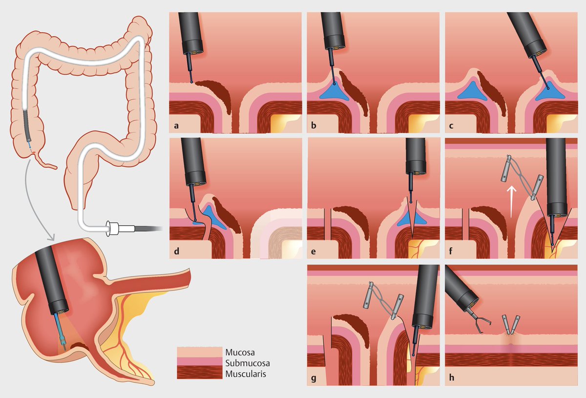 EndoscopyOthman's tweet photo. During my GI fellowship (2007 to 2010), The concept of NOTES surgery was introduced with lots of enthusiasm. With exception to POEM procedure, enthusiasm to other NOTES application quickly faded. This was mainly  due to the lack of robust closure devices and inability to triangulate with endoscopy. Recently, the introduction of excellent approximation and closure devices allowed us to venture into NOTES world again. @KeihanianTara detailed the first western experience from  Baylor St Lukes Medical Center in performing transcecal appendectomy using NOTES technique in 9 patients with colonic adenoma invading inside appendiceal lumen.  Few take home points about our case series.
* This is a pure NOTES technique in which colonoscope is advanced into peritoneal cavity to dissect the entire appendix from mesoappendix
* This technique is limited to benign TA or SSA invading deeply into appendceal lumen. The technique should not be performed for malignant lesions or mucinous appendiceal tumor to avoid peritoneal contamination.
* why this technique over EFTR? no size limitation and no risk of stump appendicitis and it ensure R0 resection in lesions extending deeply into appendix
* The alternative to this technique in these subset of patients is right hemicolectomy ( not appendectomy) since these lesion are involving the cecum too.
* CT scan is important prior to performing this technique to determine the length of the appendix ( varies from 3 to 18 cm) and to rule out any mass or advanced lesion 
* The use of traction devices and stabilization devices made our experience unique from the previously published series from the East and expedited the dissection!  #AmericanESD

https://t.co/f2qj5n6kzl