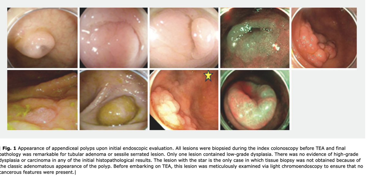 EndoscopyOthman's tweet photo. During my GI fellowship (2007 to 2010), The concept of NOTES surgery was introduced with lots of enthusiasm. With exception to POEM procedure, enthusiasm to other NOTES application quickly faded. This was mainly  due to the lack of robust closure devices and inability to triangulate with endoscopy. Recently, the introduction of excellent approximation and closure devices allowed us to venture into NOTES world again. @KeihanianTara detailed the first western experience from  Baylor St Lukes Medical Center in performing transcecal appendectomy using NOTES technique in 9 patients with colonic adenoma invading inside appendiceal lumen.  Few take home points about our case series.
* This is a pure NOTES technique in which colonoscope is advanced into peritoneal cavity to dissect the entire appendix from mesoappendix
* This technique is limited to benign TA or SSA invading deeply into appendceal lumen. The technique should not be performed for malignant lesions or mucinous appendiceal tumor to avoid peritoneal contamination.
* why this technique over EFTR? no size limitation and no risk of stump appendicitis and it ensure R0 resection in lesions extending deeply into appendix
* The alternative to this technique in these subset of patients is right hemicolectomy ( not appendectomy) since these lesion are involving the cecum too.
* CT scan is important prior to performing this technique to determine the length of the appendix ( varies from 3 to 18 cm) and to rule out any mass or advanced lesion 
* The use of traction devices and stabilization devices made our experience unique from the previously published series from the East and expedited the dissection!  #AmericanESD

https://t.co/f2qj5n6kzl