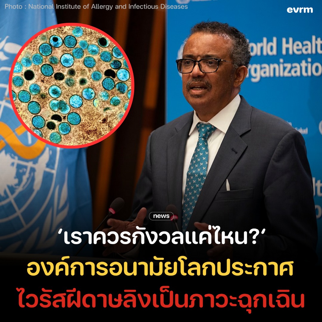 องค์การอนามัยโลก (WHO) ประกาศให้การระบาดของไวรัสฝีดาษลิง หรือ mpox เป็นภาวะะฉุกเฉินระดับนานาชาติแล้ว หลังมีผู้ป่วยจำนวนมากในคองโกและแอฟริกา รวมถึงสวีเดนที่พบเป็นรายแรกนอกทวีปแอฟริกา เราควรกังวลเรื่องนี้มากแค่ไหน?

รายงานระบุว่า mpox มีการระบาดอย่างน้อยใน 13 ประเทศของแอฟริกาแล้ว