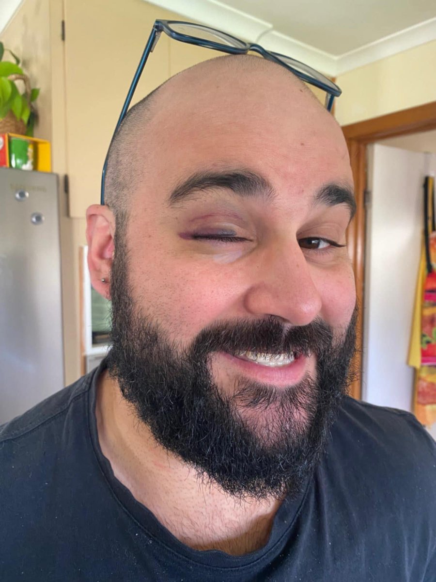 Sometimes you get a bruise or two in wrestling