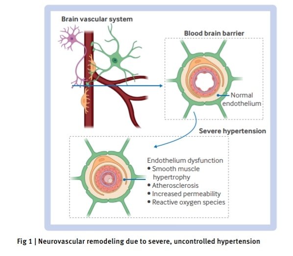 SOMELaguna's tweet photo. Evaluación y Manejo de la Emergencia Hipertensiva 🏥🫀

🔰📚BMJ 2024

doi: 10.1136/bmj‑2023-077205

Enlace a Artículo Completo 👇🏻✅🆓https://t.co/rPEDXf5xvO https://t.co/mNQLfxRwjn