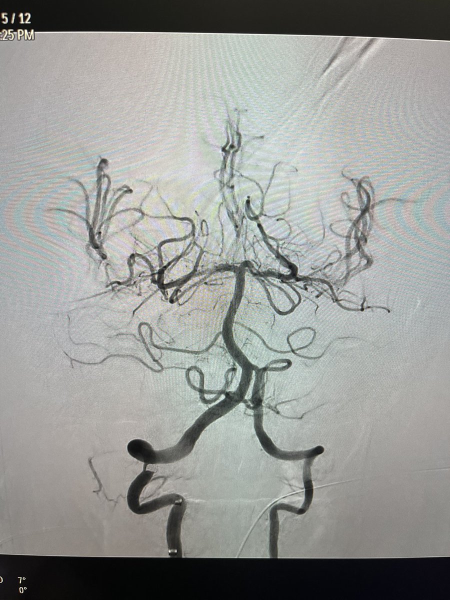 RizTahirMD's tweet photo. A @PascalJabbourMD special. Mid Basilar occlusion, Transradial thrombectomy. TICI 3 with 1 pass Zoom 71 @Imperative_Care. Puncture to recanalization = 3 min. @MedStarWHC @MGUHNeurosurg. #stroke #neurosurgery #LVO https://t.co/naqj1uDmRp