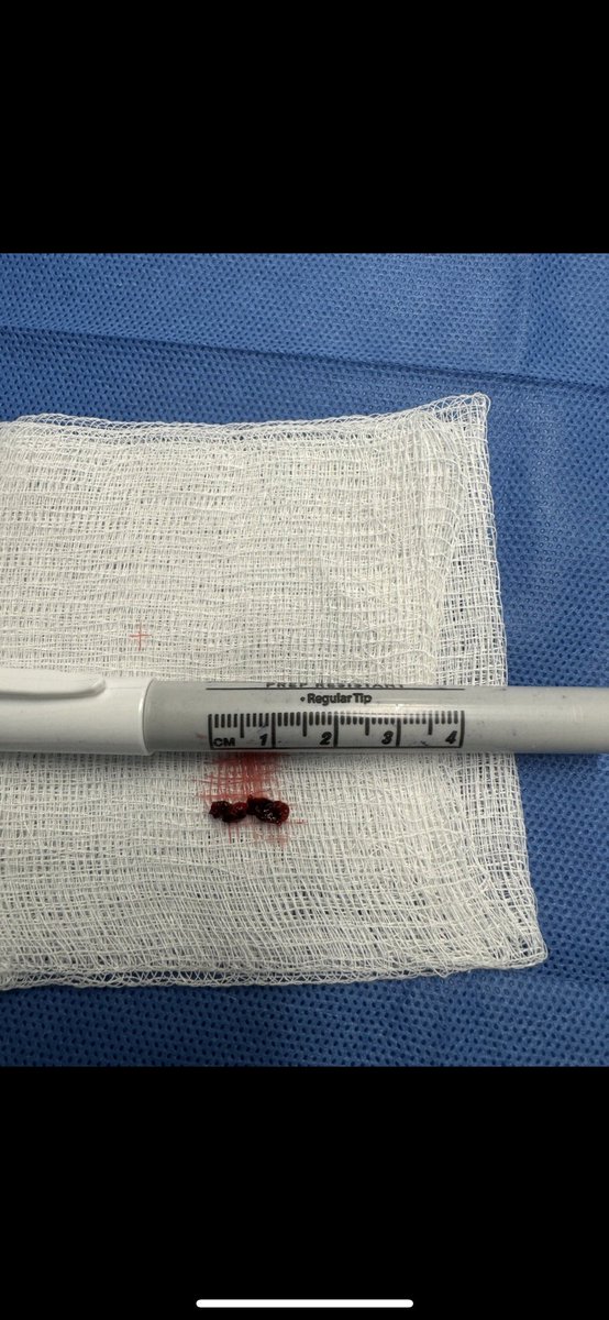 Rizwan Tahir (@riztahirmd) on Twitter photo A <a href="/PascalJabbourMD/">Pascal Jabbour MD, FAANS, FACS, FAHA</a> special. Mid Basilar occlusion, Transradial thrombectomy. TICI 3 with 1 pass Zoom 71 <a href="/Imperative_Care/">Imperative_Care</a>. Puncture to recanalization = 3 min. <a href="/MedStarWHC/">MedStar Washington</a> <a href="/MGUHNeurosurg/">Georgetown/WHC Neurosurgery</a>. #stroke #neurosurgery #LVO A <a href="/PascalJabbourMD/">Pascal Jabbour MD, FAANS, FACS, FAHA</a> special. Mid Basilar occlusion, Transradial thrombectomy. TICI 3 with 1 pass Zoom 71 <a href="/Imperative_Care/">Imperative_Care</a>. Puncture to recanalization = 3 min. <a href="/MedStarWHC/">MedStar Washington</a> <a href="/MGUHNeurosurg/">Georgetown/WHC Neurosurgery</a>. #stroke #neurosurgery #LVO