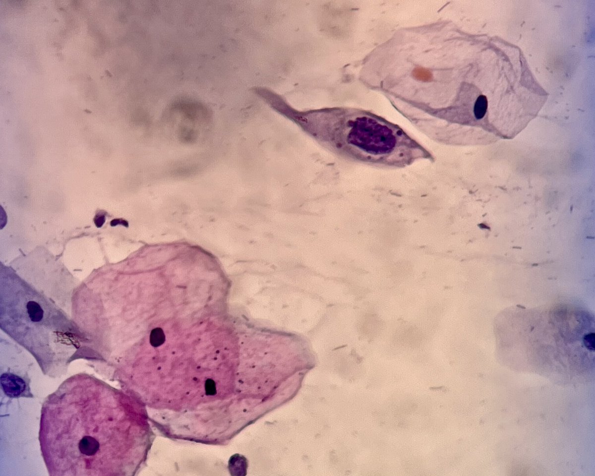 MonicaModesto's tweet photo. Cromatina revelando, e muito, a essência da lesão. Amostra de um exame de rotina em uma citologia cervico-vaginal. 😉 https://t.co/eje1RGFfEz