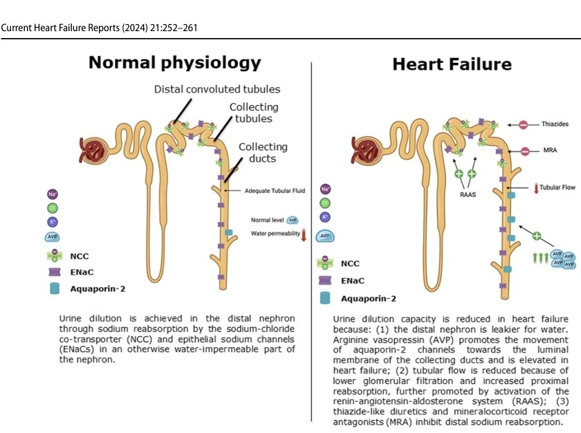 LeslieMegom's tweet photo. ⚖️🧂Evaluación y manejo de la hiponatremia en la insuficiencia cardíaca.🫀
🧂Hponatremia grave se define por niveles séricos de sodio <125 mEq/L.
🧂⤵️ hiponatremia aguda ( <48h)
🧵👇 https://t.co/mdniOzs1M9