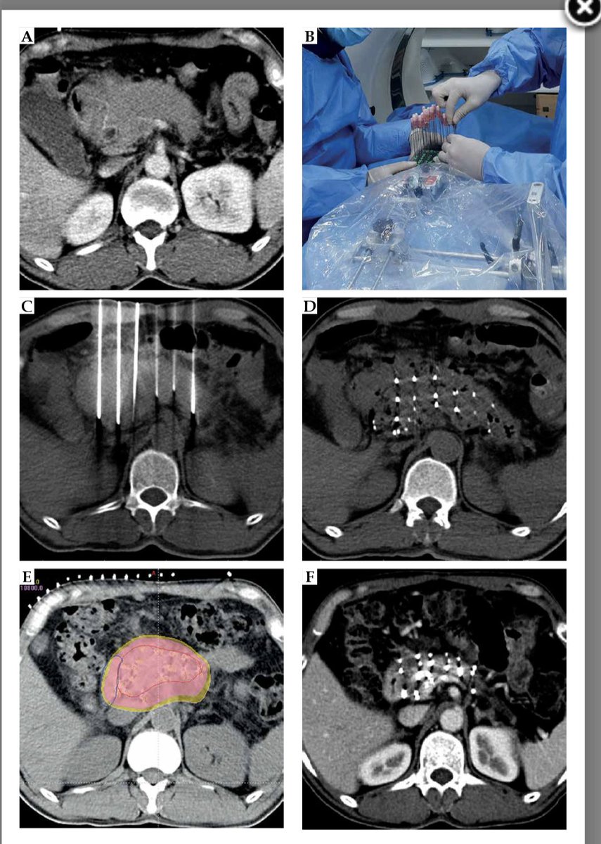 Just saw this permanent iodine brachytherapy paper for inoperable pancreas ca and it's really amazing.  20x20 template implant into the pancreas using lidocaine &amp; breath hold. The liver and bowel could be penetrated during seed implantation if necessary.  PMID: 35494180  #radonc