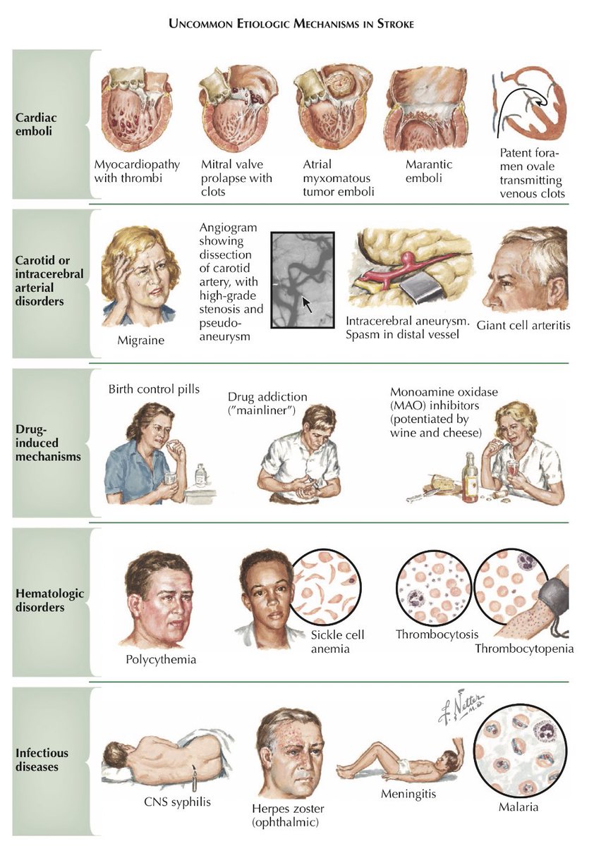 OGdukeneurosurg's tweet photo. Uncommon Stroke Causes https://t.co/9k8ASaf0wJ