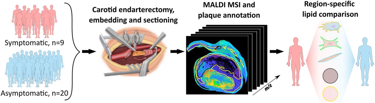 The investigation of the region-specific lipid composition of symptomatic and asymptomatic human ath plaques reveals specific lipid markers of plaque outcome which could be linked to known biological characteristics of stable plaques
🔗atherosclerosis-journal.com/article/S0021-…
<a href="/society_eas/">European Atherosclerosis Society</a>