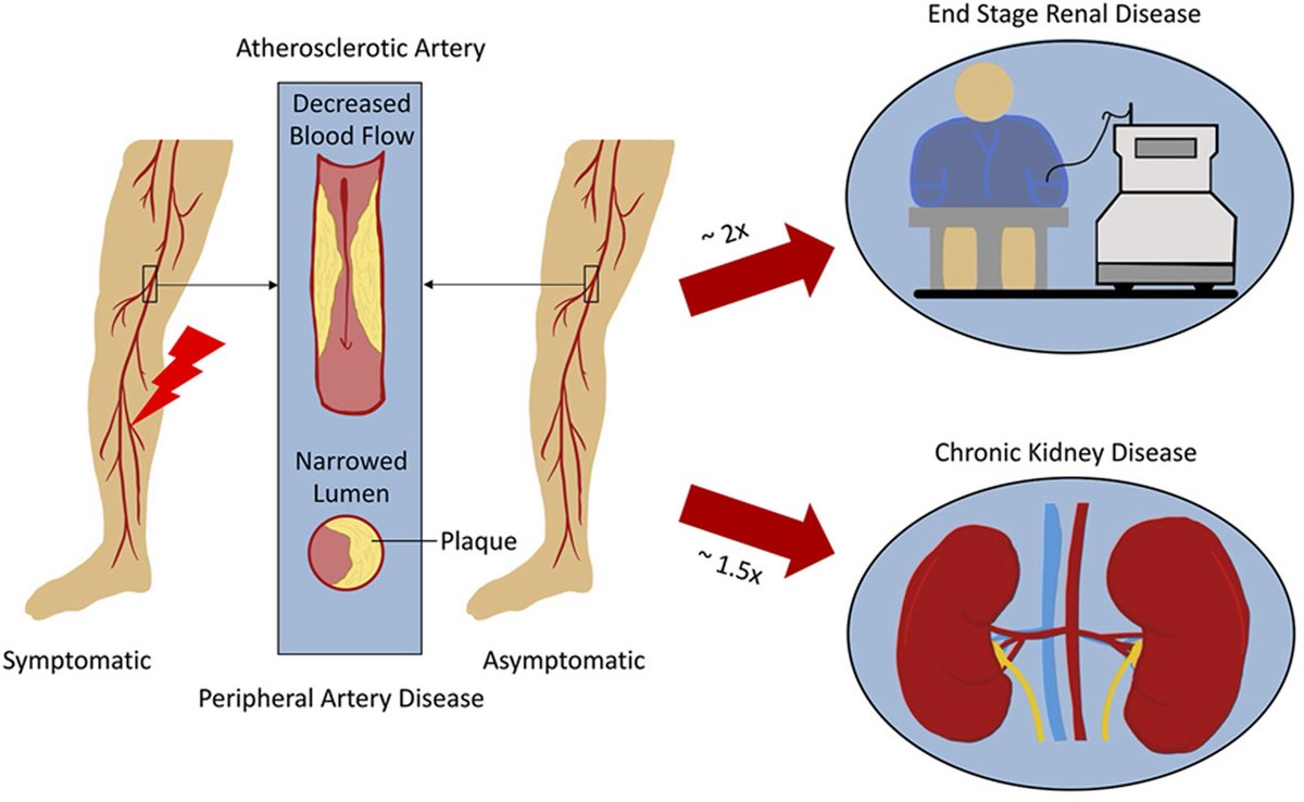 Atherosclerosis (@athjournal) on Twitter photo 👫 w/ PAD have a 1.5-2x higher risk of incident end-stage kidney disease and chronic kidney disease. The 25-year cumulative incidence for ESKD is ∼10% in symptomatic PAD and asymptomatic PAD vs. 4-5% in no PAD
🔗atherosclerosis-journal.com/article/S0021-…
<a href="/society_eas/">European Atherosclerosis Society</a> <a href="/ELS_Cardiology/">Elsevier Cardiology</a> #EASSoMe 👫 w/ PAD have a 1.5-2x higher risk of incident end-stage kidney disease and chronic kidney disease. The 25-year cumulative incidence for ESKD is ∼10% in symptomatic PAD and asymptomatic PAD vs. 4-5% in no PAD
🔗atherosclerosis-journal.com/article/S0021-…
<a href="/society_eas/">European Atherosclerosis Society</a> <a href="/ELS_Cardiology/">Elsevier Cardiology</a> #EASSoMe