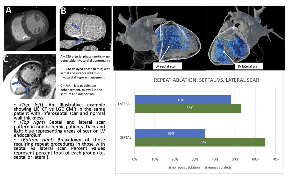 Journal of Cardiovascular Electrophysiology (@jcardioep) on Twitter photo 📌New in <a href="/JCardioEP/">Journal of Cardiovascular Electrophysiology</a>
"Septal late enhancement by cardiac CT is associated with repeat ablation in nonischemic cardiomyopathy patients" by <a href="/leahjohnMD/">Leah A. John, MD MBA</a>
<a href="/sanjaydivakaran/">Sanjay Divakaran</a> <a href="/RonBlankstein/">Ron Blankstein</a> <a href="/UBatnyam_EP/">Uyanga Batnyam</a>
<a href="/True_EP/">William H. Sauer, MD</a> <a href="/JRWinterfield/">Jeffrey Winterfield</a> <a href="/utedrow/">Usha Tedrow</a>
📷onlinelibrary.wiley.com/doi/10.1111/jc……
#EPeeps 📌New in <a href="/JCardioEP/">Journal of Cardiovascular Electrophysiology</a>
"Septal late enhancement by cardiac CT is associated with repeat ablation in nonischemic cardiomyopathy patients" by <a href="/leahjohnMD/">Leah A. John, MD MBA</a>
<a href="/sanjaydivakaran/">Sanjay Divakaran</a> <a href="/RonBlankstein/">Ron Blankstein</a> <a href="/UBatnyam_EP/">Uyanga Batnyam</a>
<a href="/True_EP/">William H. Sauer, MD</a> <a href="/JRWinterfield/">Jeffrey Winterfield</a> <a href="/utedrow/">Usha Tedrow</a>
📷onlinelibrary.wiley.com/doi/10.1111/jc……
#EPeeps