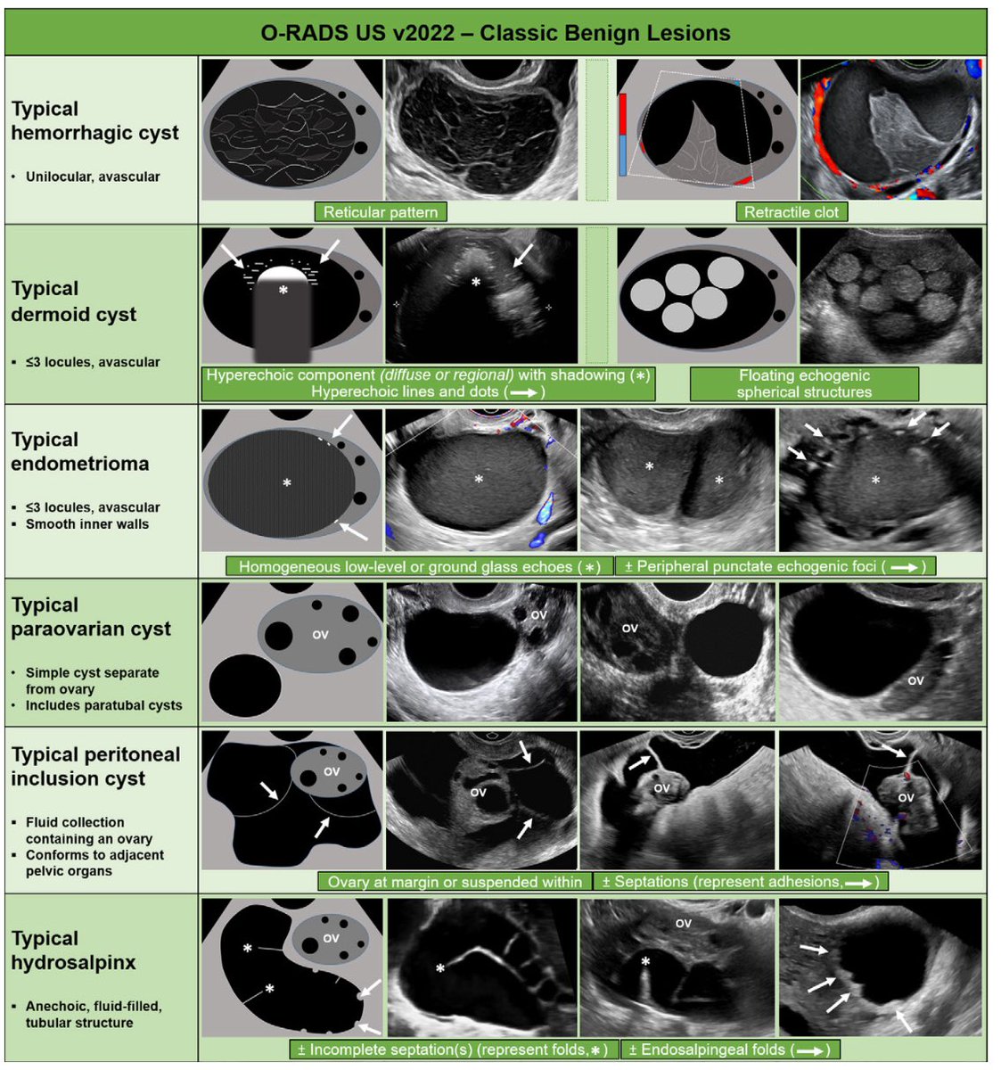 JorgeMincholaVe's tweet photo. Se espera que los cambios realizados en #ORADS US mejoren la especificidad de las lesiones de menor riesgo y facilite una interpretación más estandarizada de las imágenes de #ovario y anexos. #ultrasound
📌 https://t.co/OosdiF5otl https://t.co/xrSDwGAht1
