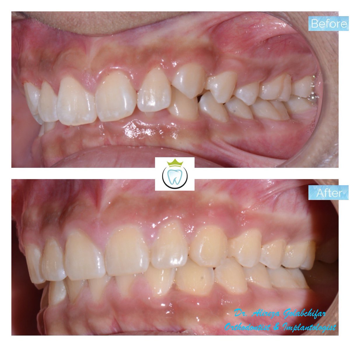 dentistry_king's tweet photo. Check out this Transformation!
We utilized growth modification appliances and braces to achieve this fantastic result! No teeth were removed!!
#orthodontics #braces #smile #smiletransformation #cosmeticdentistry #orthosmiletoronto #dentistry #empresswalkdental #kingwestdentistry https://t.co/AlPf5cgiCN