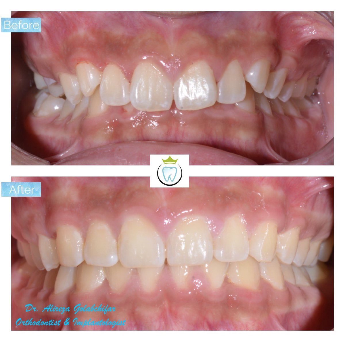 dentistry_king's tweet photo. Check out this Transformation!
We utilized growth modification appliances and braces to achieve this fantastic result! No teeth were removed!!
#orthodontics #braces #smile #smiletransformation #cosmeticdentistry #orthosmiletoronto #dentistry #empresswalkdental #kingwestdentistry https://t.co/AlPf5cgiCN