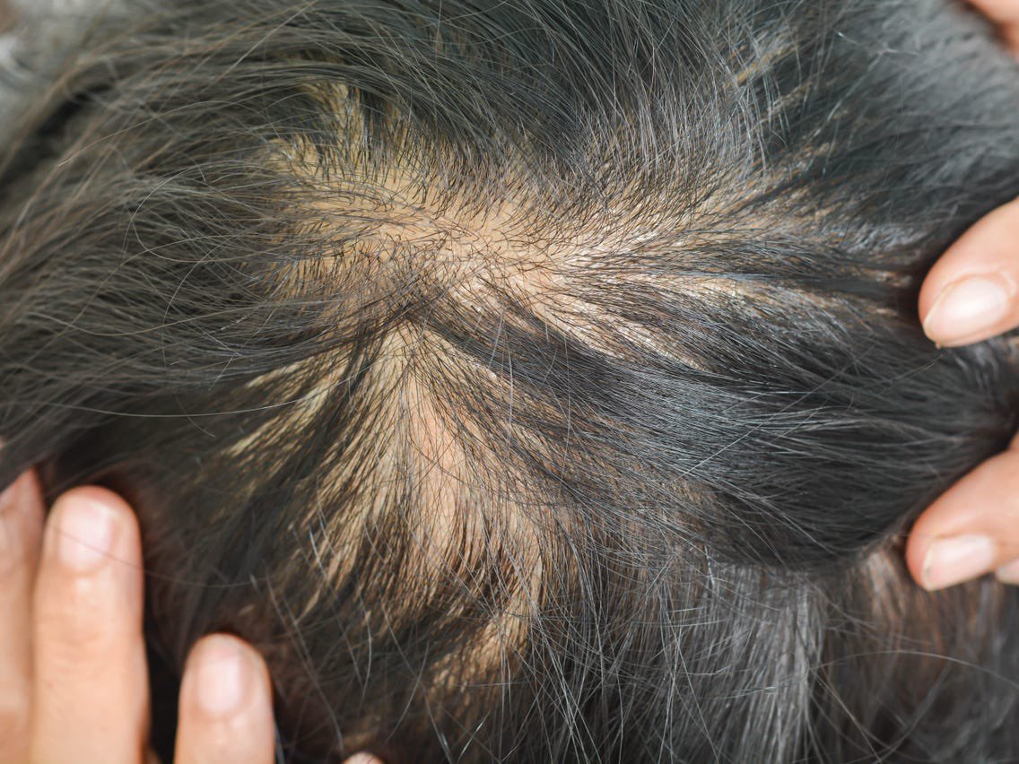 Kalau rambut korang jenis nipis/jarang, mudah gugur/breakage, YOU’RE NOT ALONE.

According to the American Academy of Dermatology, approx. 40% of women experience hair loss by the time they’re 50. Lelaki? Ramai by 40 dah ada bald spot🤯

That’s where the best hair growth oils