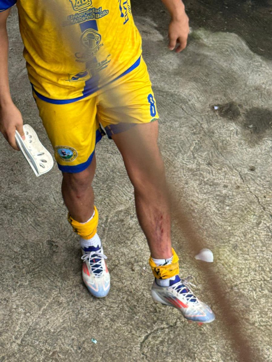 <a href="/CDMLimeno/">Club Deportivo Municipal Limeño</a> Le pegan a Gerson Mayen una gran patada y a el lo expulsan 🟥.  Mal arbitraje el día de hoy 😳