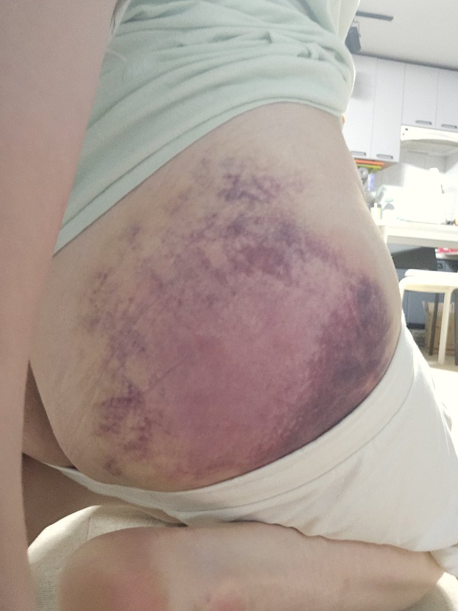 내엉덩이가 어케된거야ㅋㅋㅋ
이봐 때렸으면 케어해줘야지 ㅋㅋ