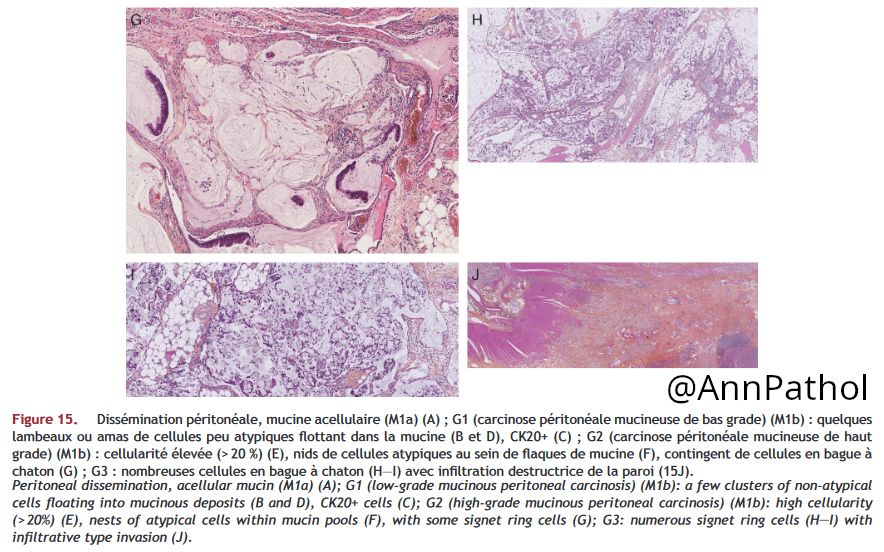 Annpathol's tweet photo. 🇲🇫 Pseudomyxome peritoneal
🇬🇧 Peritoneal pseudomyxoma
📰 Retrouvez l'article sur les néoplasies mucineuses appendiculaires pr P. Dartigues
👉 https://t.co/XN4ibiXn9f
🔬 #pathology #gipath #francophonepath https://t.co/dZvRSK9ohR