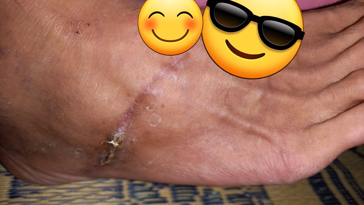こんばんわーーー
まだ労災生活です(-_-;)
やっとぐるぐる包帯生活おわりました!щ(゜▽゜щ)イェーイ　2カ月半ぶりくらいに29センチの右足洗った-w　気持ちよかったです！(￣▽￣;)　神経やってるんで飲み薬と湿布生活始まります(-_-;)　まだ靴が痛くて履けないよさ