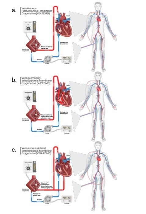 Leo_Santo5's tweet photo. 💎ECMO en el Manejo de la Insuficiencia Respiratoria 🤯🫁

🧬Fisiología
☝🏻Indicaciones
📄Nomenclatura
🌬️Manejo del VM
🆘Complicaciones
🙂‍↕️Weaning

🔰📚J.Clin. Medicina  2024

https://t.co/hXuWB4XFun

Enlace a Artículo Completo 👇🏻✅🆓https://t.co/xumUMHaxVK https://t.co/vJ2xDttxGA