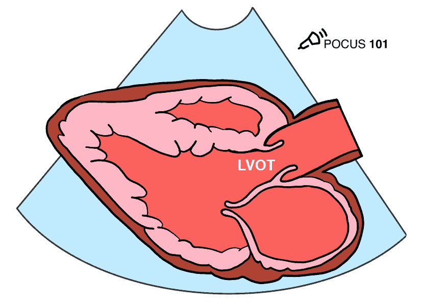 EmergPOCUS's tweet image. 🫀Cómo Medir el #Gasto_Cardíaco con Ecocardiografía de Manera Súper Fácil 📏

🚶🏽‍♂️ ¡Aquí te explico cómo hacerlo paso a paso! 🚶🏽‍♂️

          (👇🏼 🧵 🪡 #HILO 🪡 🧵👇🏼) 

🪜 PASO 1: Obtén la Ventana Paraesternal en Eje Largo (PSLA)

- 👁️ Visualiza el Tracto de Salida del Ventrículo…