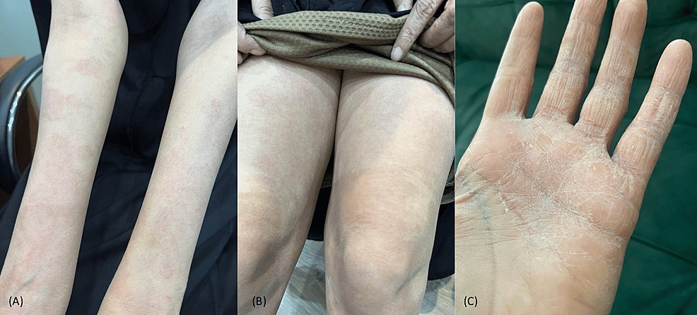 Aller_MD's tweet photo. #Pityriasis #Rubra #Pilaris in an #Atopic #Dermatitis Patient: A Case Report https://t.co/eKsPi2yg1U https://t.co/N9bFpxqh9k