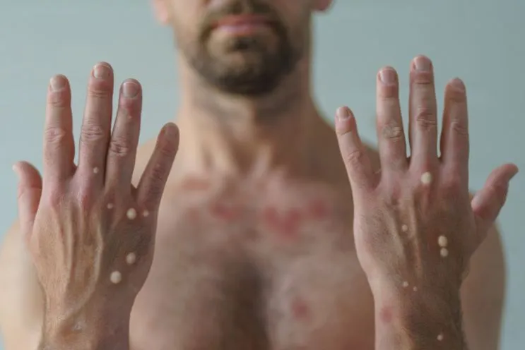 bitcoinmalaya's tweet photo. 🚨WHO declares mpox (monkeypox) outbreak a public health emergency of international concern.

What is mpox? 

Is that really "gay disease" as stereoptyped?

8 key facts about mpox 🧵