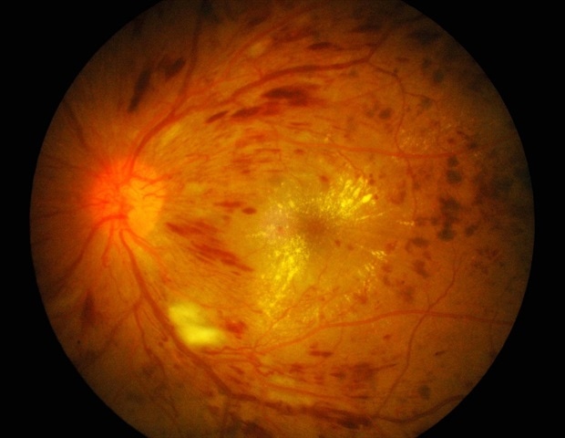 $3.3 million study to explore eye health in patients with prediabetes and diabetes dlvr.it/TC6S7f