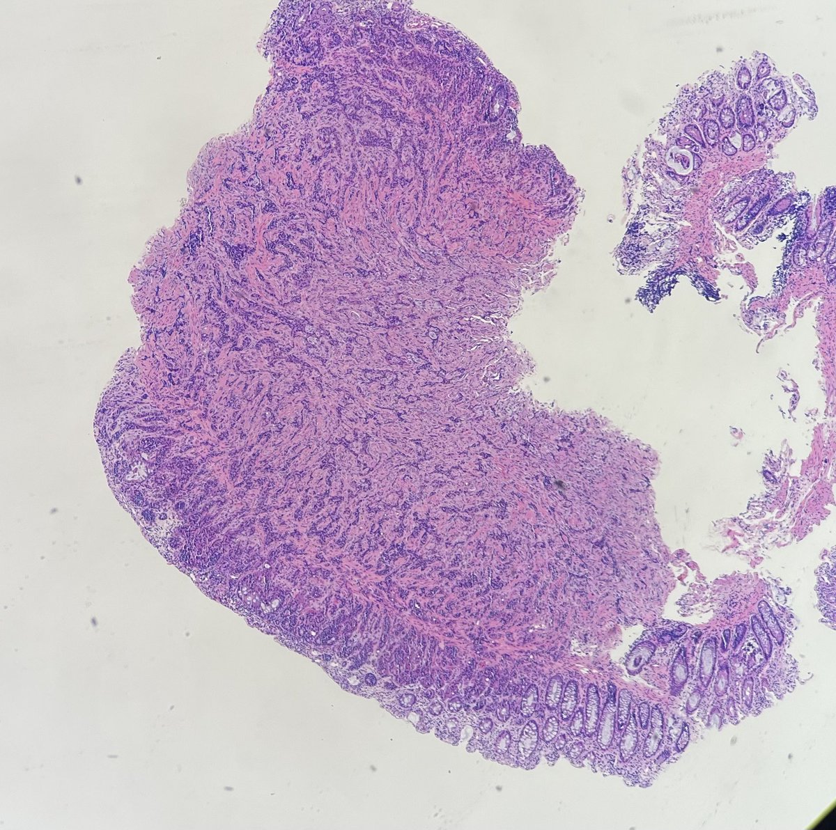 pierocarames25's tweet photo. 50yo patient with a 1 cm rectal polyp. Dx? https://t.co/6bJNoNB5Lz