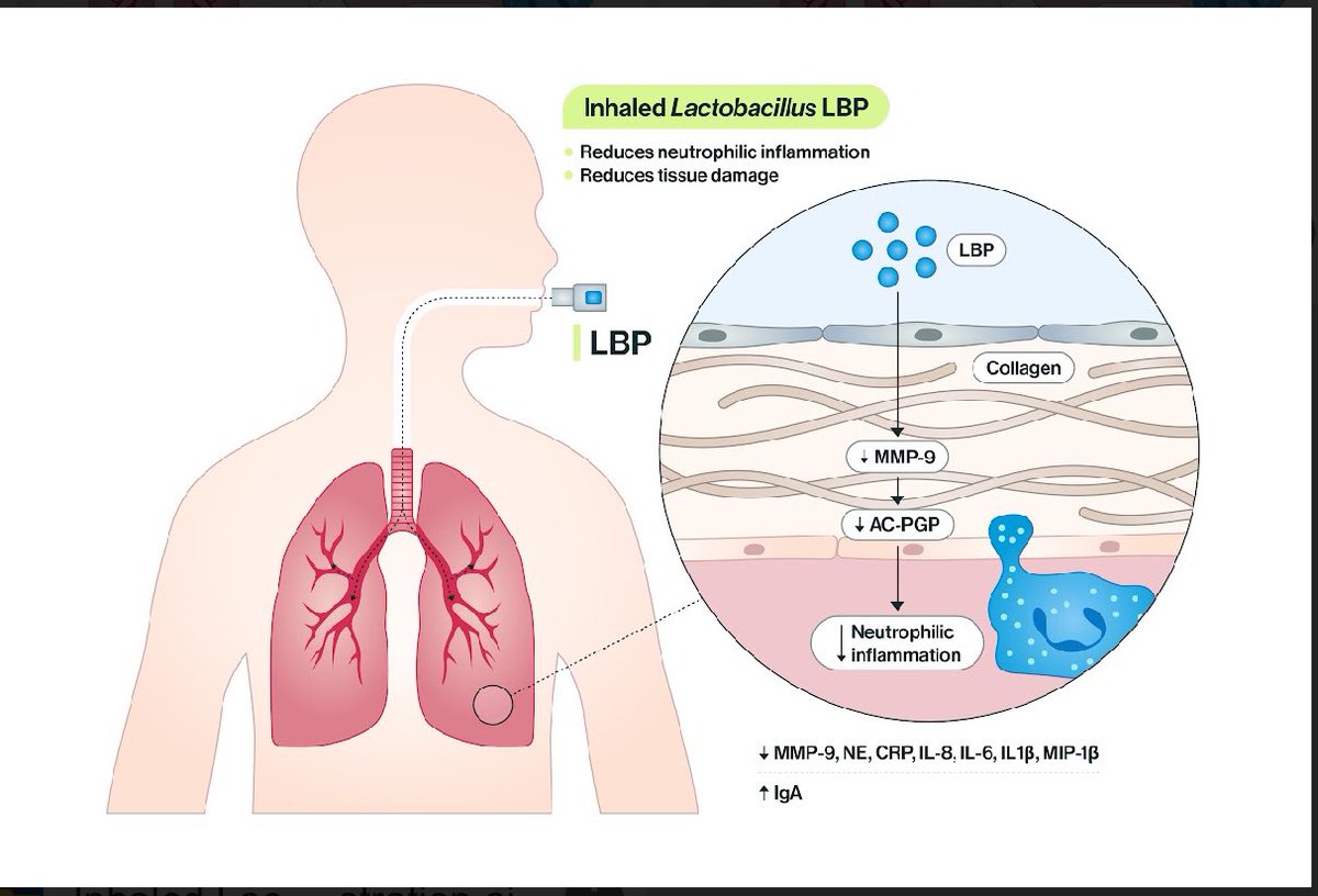 C. Vivek Lal (@cviveklal) on Twitter photo Thrilled to share our team’s <a href="/NatureComms/">Nature Communications</a> paper on the 1st inhaled live biotherapeutics for chronic lung disease! Years of hard work & bold thinking led us to engineer “air as medicine.” Proud to see this work moving forward at <a href="/AlveolusBio/">Alveolus Bio</a> with phase 1b trials soon! <a href="/UABHeersink/">UAB Heersink School of Medicine</a> Thrilled to share our team’s <a href="/NatureComms/">Nature Communications</a> paper on the 1st inhaled live biotherapeutics for chronic lung disease! Years of hard work & bold thinking led us to engineer “air as medicine.” Proud to see this work moving forward at <a href="/AlveolusBio/">Alveolus Bio</a> with phase 1b trials soon! <a href="/UABHeersink/">UAB Heersink School of Medicine</a>