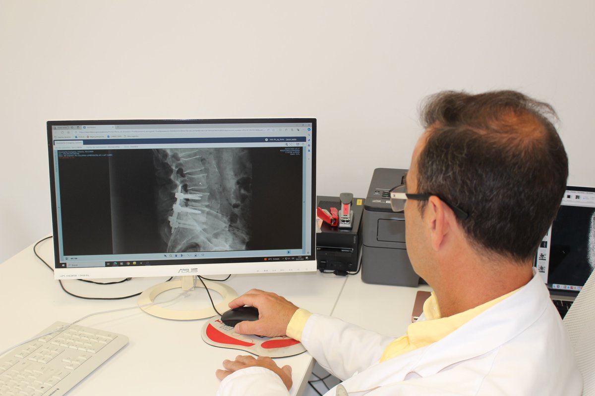RX de paciente tras cirugía de #artrodesis vertebral en  segmento L4-L5-S1.
Consiste en la estabilización vertebral mediante la unión de segmentos vertebrales a través de un injerto óseo obtenido de la cresta ilíaca posterior.
Causas
👉Discopatía degenerativa
👉Espondilolistesis