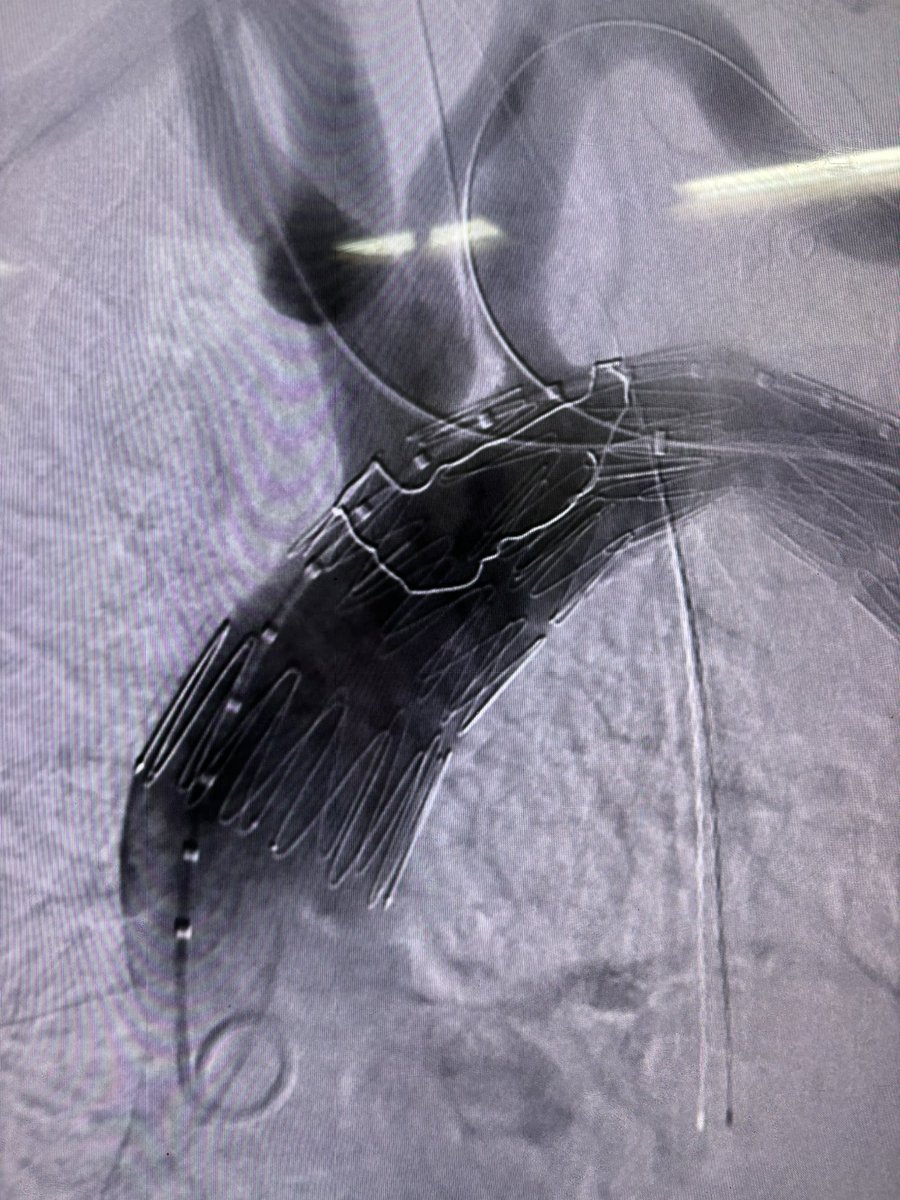 woostermd (@woostermd) on Twitter photo Another day, another #aorta treated with multidisciplinary collaborative care “team work makes the dream work”. <a href="/DrZeigler1/">Aorta guy</a> <a href="/MUSCVascular/">MUSC Vascular Surgery</a> <a href="/MUSCSurgery/">MUSC Department of Surgery</a> <a href="/MUSChealth/">MUSC Health</a> Another day, another #aorta treated with multidisciplinary collaborative care “team work makes the dream work”. <a href="/DrZeigler1/">Aorta guy</a> <a href="/MUSCVascular/">MUSC Vascular Surgery</a> <a href="/MUSCSurgery/">MUSC Department of Surgery</a> <a href="/MUSChealth/">MUSC Health</a>
