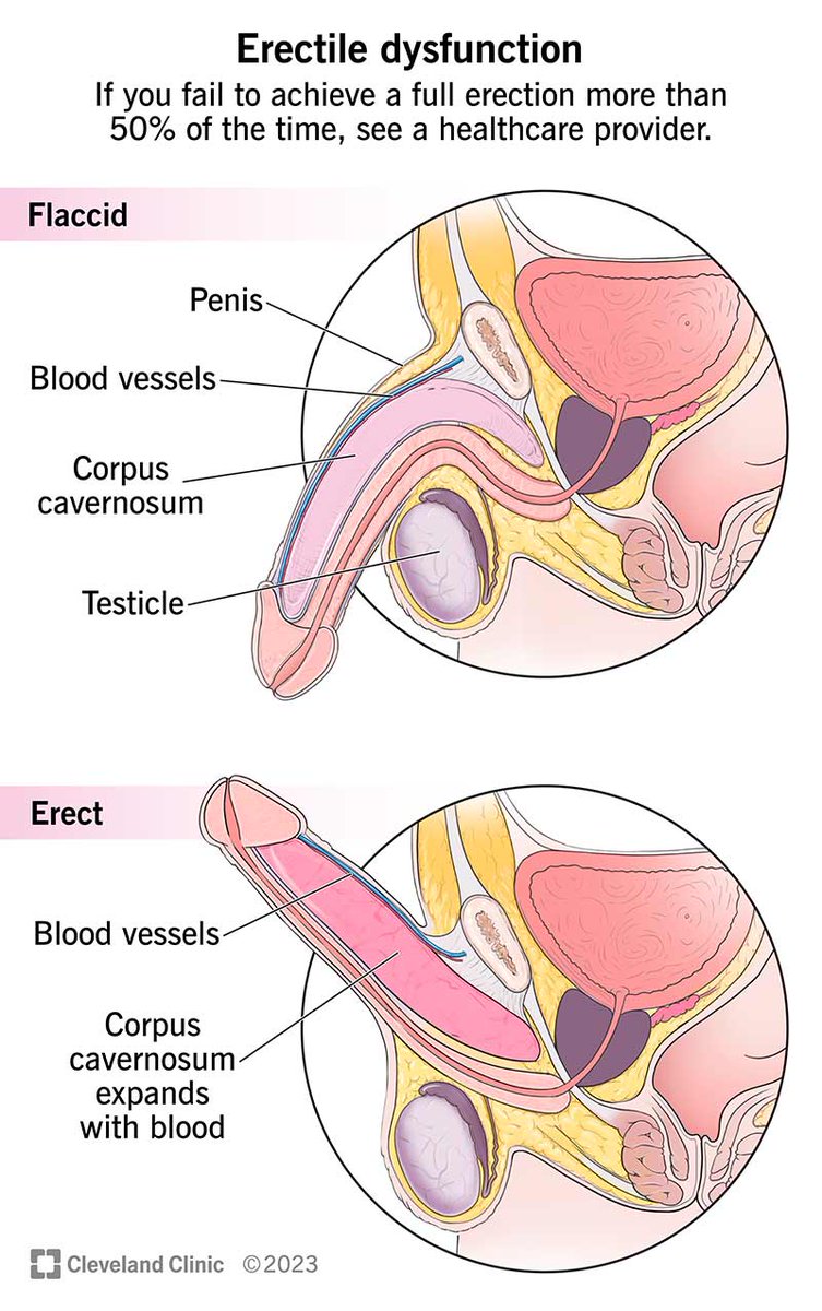 2 minute man. 1 hour man.
What if I told you that as long as your partner is happy, you're good to go?
There's no law that says a man must last 30 minutes in a woman, but it's actually a problem if he lasts less than a minute after insertion. Let's look at reasons for this🧵👇🏼