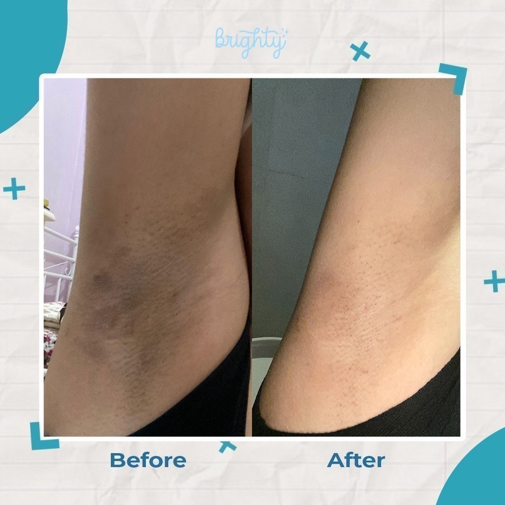 DiskonFlash's tweet photo. ✨ Brighty Glowing Underarm Pemutih Ketiak Dan Selangangan No1 Di Indonesia Mencerahkan Memutihkan Pencerah Ketiak Selangka...✨

Ini linknya ya 👇                
https://t.co/FAaPWh7r9k https://t.co/RwAdtgyQC6