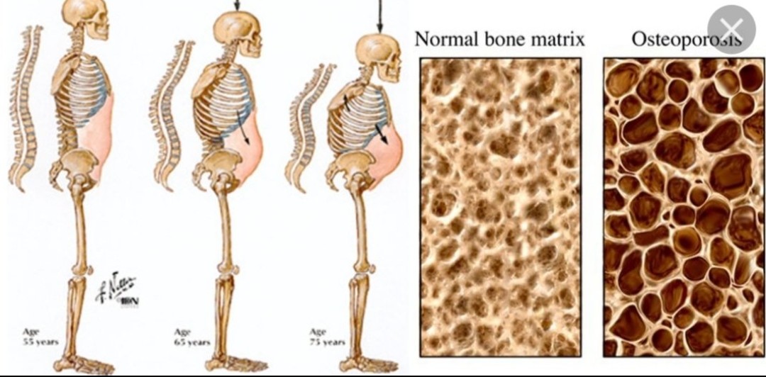 في بحث رائع عن تاثير العسل على كثافة العظام 

وجد ان ٢٠جم يوميا من العسل ولمده اربعة اشهر ادى نفس مفعول العلاج الهرموني HRT وألذي يعطى  كعلاج لهشاشه العظام وخاصه للنساء بعد انقطاع الدوره .

البحث في الردود اسفل التغريدة