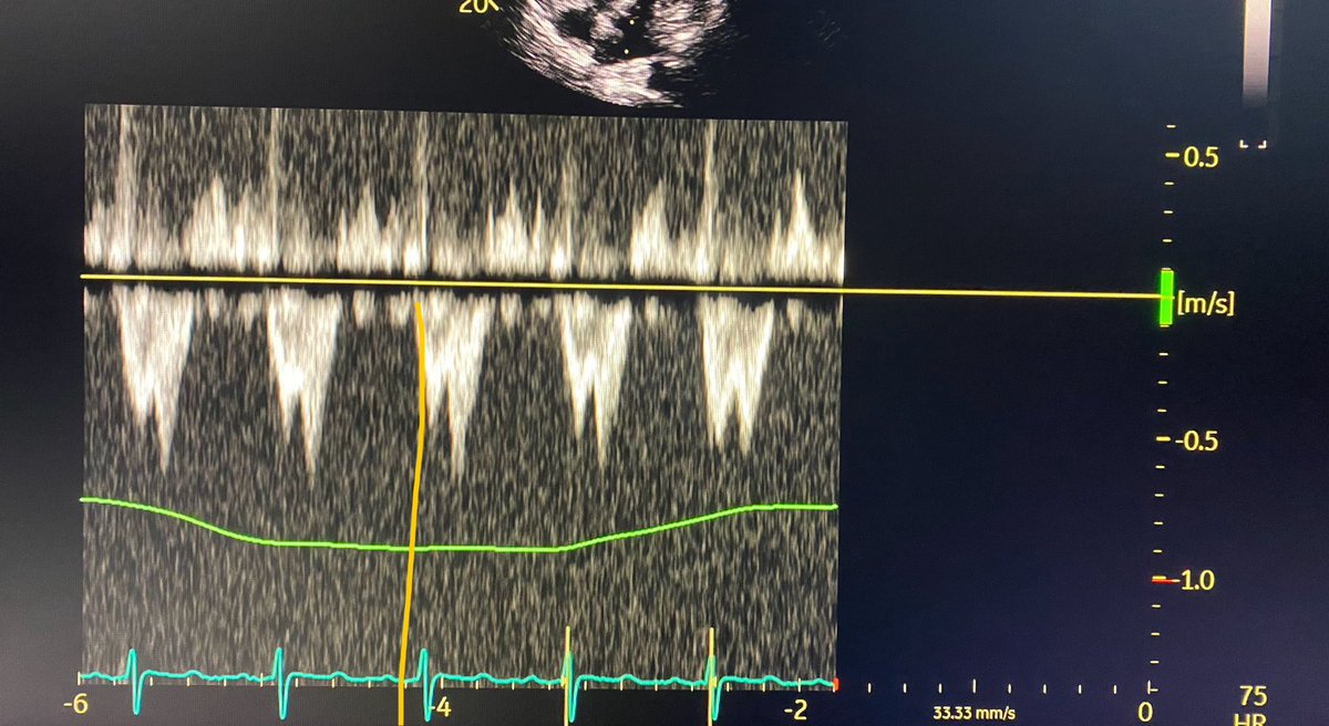 Mehnaz Rahman, M.D. (@mehnazrahmanmd) on Twitter photo Fellows- When can we see this PW LVOT pattern?. Of note, There is no EA reversal in mitral inflow. <a href="/ASE360/">American Society of Echocardiography</a> #Echofirst #ACCEarlyCareer Fellows- When can we see this PW LVOT pattern?. Of note, There is no EA reversal in mitral inflow. <a href="/ASE360/">American Society of Echocardiography</a> #Echofirst #ACCEarlyCareer