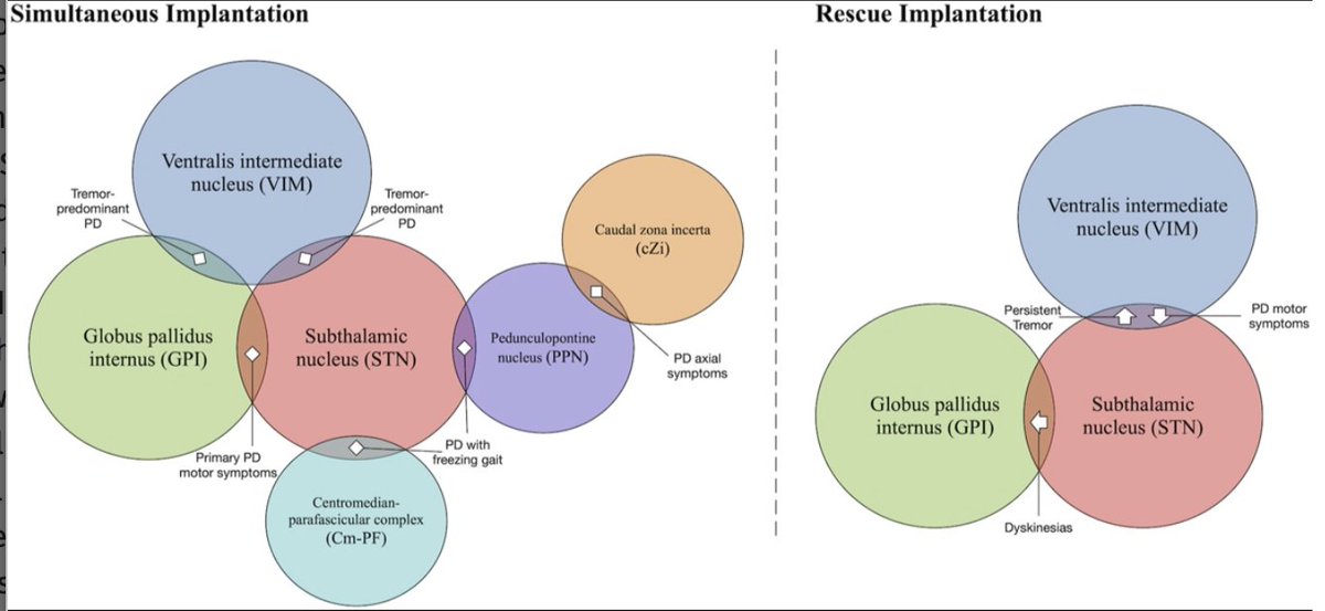 Neurosurgery Publications (@neurosurgerycns) on Twitter photo #ONSNew Rescue Lead Implantation After Deep Brain Stimulation for Parkinson's Disease: A Single-Center Experience and Case Series bit.ly/46VWPR9 by <a href="/zaneschnurman/">Zane Schnurman</a> et al <a href="/nyugrossman/">NYU Grossman School of Medicine</a> <a href="/DKondziolkaCNS/">Douglas Kondziolka</a> <a href="/CNS_Update/">CNS</a> <a href="/george_maragkos/">George Maragkos, MD</a> <a href="/Zaazoue/">Mohamed Zaazoue</a> <a href="/jh_kanterMD/">John Kanter</a> <a href="/LKReedMD/">Laura K. Reed, MD</a> <a href="/e_celano/">Emma Celano</a> #ONSNew Rescue Lead Implantation After Deep Brain Stimulation for Parkinson's Disease: A Single-Center Experience and Case Series bit.ly/46VWPR9 by <a href="/zaneschnurman/">Zane Schnurman</a> et al <a href="/nyugrossman/">NYU Grossman School of Medicine</a> <a href="/DKondziolkaCNS/">Douglas Kondziolka</a> <a href="/CNS_Update/">CNS</a> <a href="/george_maragkos/">George Maragkos, MD</a> <a href="/Zaazoue/">Mohamed Zaazoue</a> <a href="/jh_kanterMD/">John Kanter</a> <a href="/LKReedMD/">Laura K. Reed, MD</a> <a href="/e_celano/">Emma Celano</a>