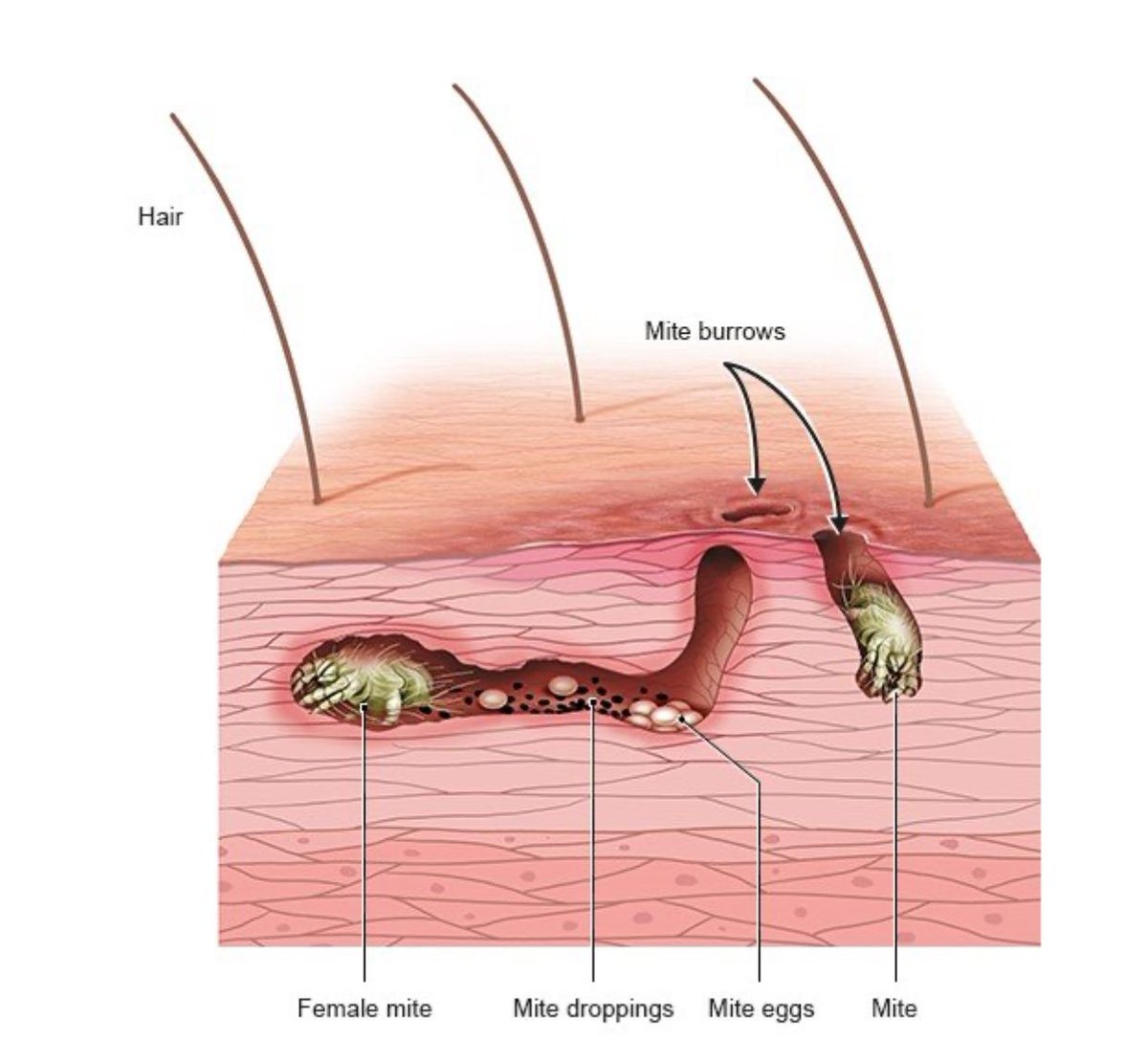 Escape2SEA's tweet photo. Scabies

📋 Cause:
- The cause of scabies is an infestation by the microscopic mite Sarcoptes scabiei. 
- The mites are typically spread through direct, prolonged skin-to-skin contact with an infected person.
- The female mites burrow into the skin to lay eggs, which hatch and mature, continuing the infestation cycle.

Symptoms:
- Intense itching, especially at night.
- Red, blister-like bumps or pimple-like eruptions, often accompanied by small burrow tracks made by the mites.

📸 Picture Reference: Informedhealth