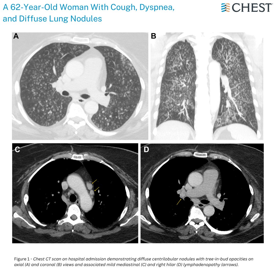 CHEST® Journal (@journal_chest) on Twitter photo A 62-Year-Old Woman With Cough, Dyspnea, and Diffuse Lung Nodules
What's the diagnosis? Read the full research in the August issue to find out: hubs.la/Q02MC9xC0
#MedEd #JournalCHEST A 62-Year-Old Woman With Cough, Dyspnea, and Diffuse Lung Nodules
What's the diagnosis? Read the full research in the August issue to find out: hubs.la/Q02MC9xC0
#MedEd #JournalCHEST