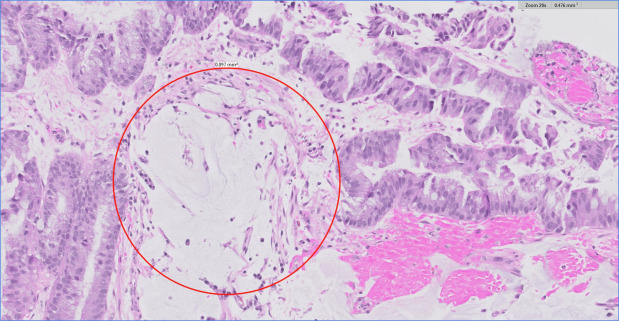 VideoGIE Journal (@videogie) on Twitter photo VideoGIE Editor's Choice: “High-resolution optical pancreatoscopy for recurrent main-duct intraductal papillary mucinous neoplasms” by Shaurya Prakash et al. videogie.org/article/S2468-…
<a href="/KaraRaphael/">Kara Raphael</a> VideoGIE Editor's Choice: “High-resolution optical pancreatoscopy for recurrent main-duct intraductal papillary mucinous neoplasms” by Shaurya Prakash et al. videogie.org/article/S2468-…
<a href="/KaraRaphael/">Kara Raphael</a>
