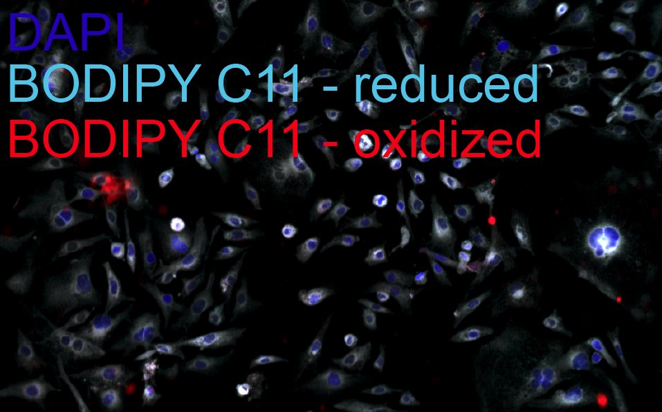Chordoma Foundation Labs (@cflabsresearch) on Twitter photo Inspired by findings from <a href="/TSharifnia/">Tanaz Sharifnia</a> & <a href="/SchreiberStuart/">Stuart Schreiber</a> that GPX4 is essential in chordoma, we’ve demonstrated that GPX4 inhibition induces ferroptotic cell death, suggesting ferroptosis susceptibility may be a targetable vulnerability in chordoma. Results now on <a href="/figshare/">Figshare</a>. Inspired by findings from <a href="/TSharifnia/">Tanaz Sharifnia</a> & <a href="/SchreiberStuart/">Stuart Schreiber</a> that GPX4 is essential in chordoma, we’ve demonstrated that GPX4 inhibition induces ferroptotic cell death, suggesting ferroptosis susceptibility may be a targetable vulnerability in chordoma. Results now on <a href="/figshare/">Figshare</a>.