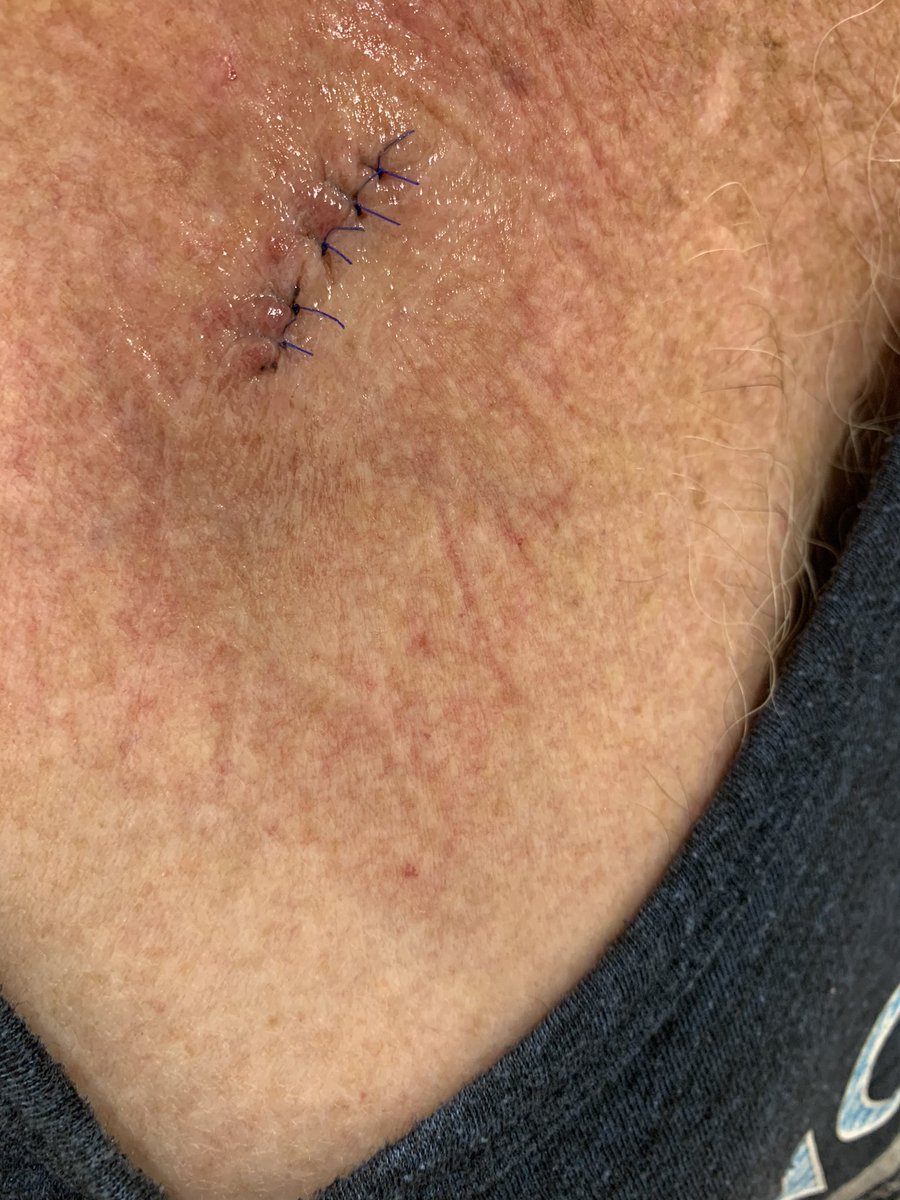 Get checked out Lads, there’s another 10stitches round the back on the Shoulder🤦‍♂️
#spf50