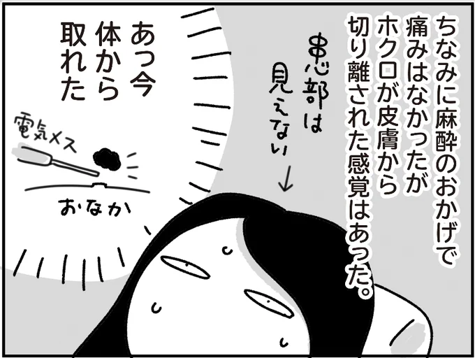 ブログ更新しました。ホクロの話はこれで終わりです。  ホクロを取った話 その3 - ちょっ子さん 