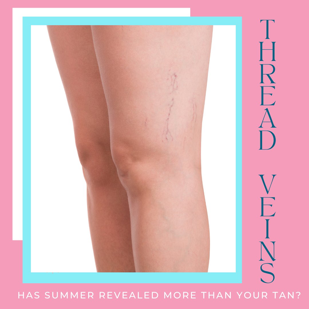 MaidstoneLaser's tweet photo. Has summer left you seeing red? ❌ Don't let thread veins steal your shine! ✨ Our electrolysis treatments offer effective and painless thread vein removal. Book your consultation today! 📞 01622 758635 
#threadveintreatment #threadveinremoval #painless  #maidstone #kent https://t.co/pRWGOl4BJz