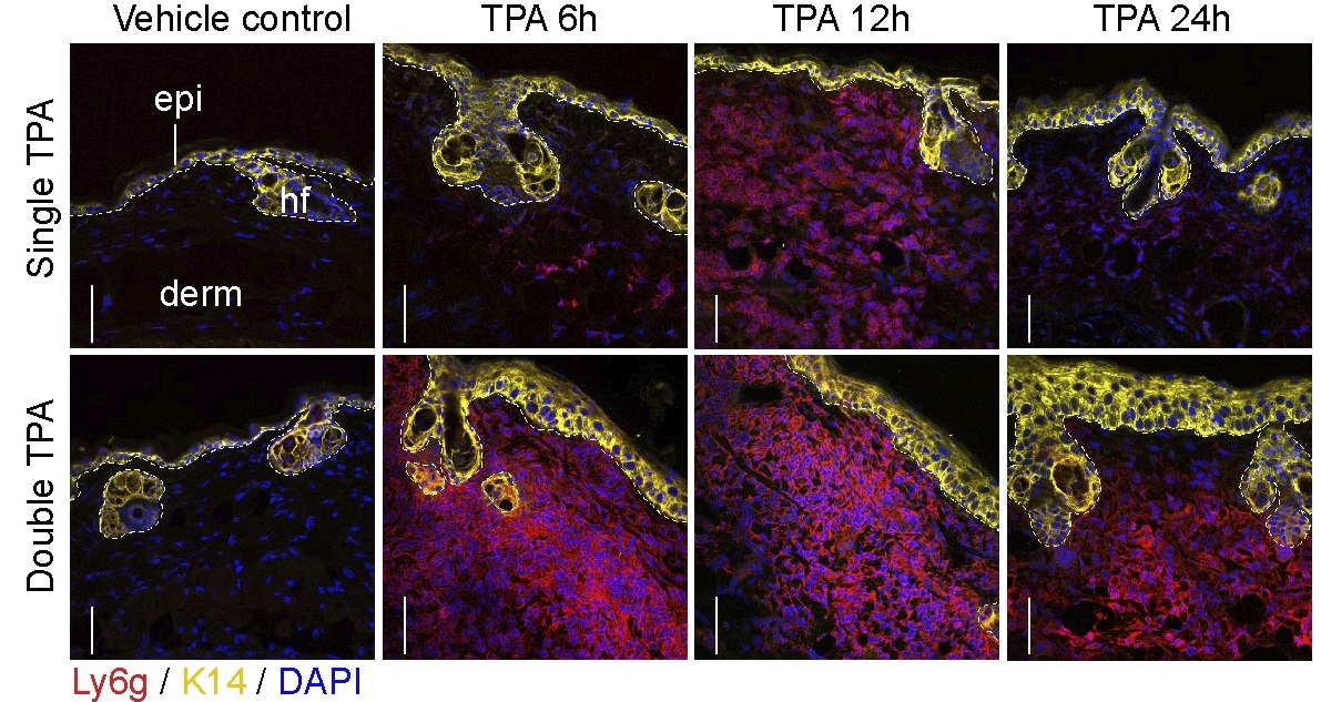 PLOS Biology (@plosbiology) on Twitter photo During chronic #inflammatory diseases, how are neutrophils recruited to inflamed #skin? <a href="/PierreCoulombe8/">Pierre Coulombe</a> <a href="/parentclab/">Carole Parent Lab</a> &co show that repeated acute stress to the skin amplifies a #neutrophil infiltration response involving keratin 17 & PKCα #PLOSBiology plos.io/3WVA62O During chronic #inflammatory diseases, how are neutrophils recruited to inflamed #skin? <a href="/PierreCoulombe8/">Pierre Coulombe</a> <a href="/parentclab/">Carole Parent Lab</a> &co show that repeated acute stress to the skin amplifies a #neutrophil infiltration response involving keratin 17 & PKCα #PLOSBiology plos.io/3WVA62O