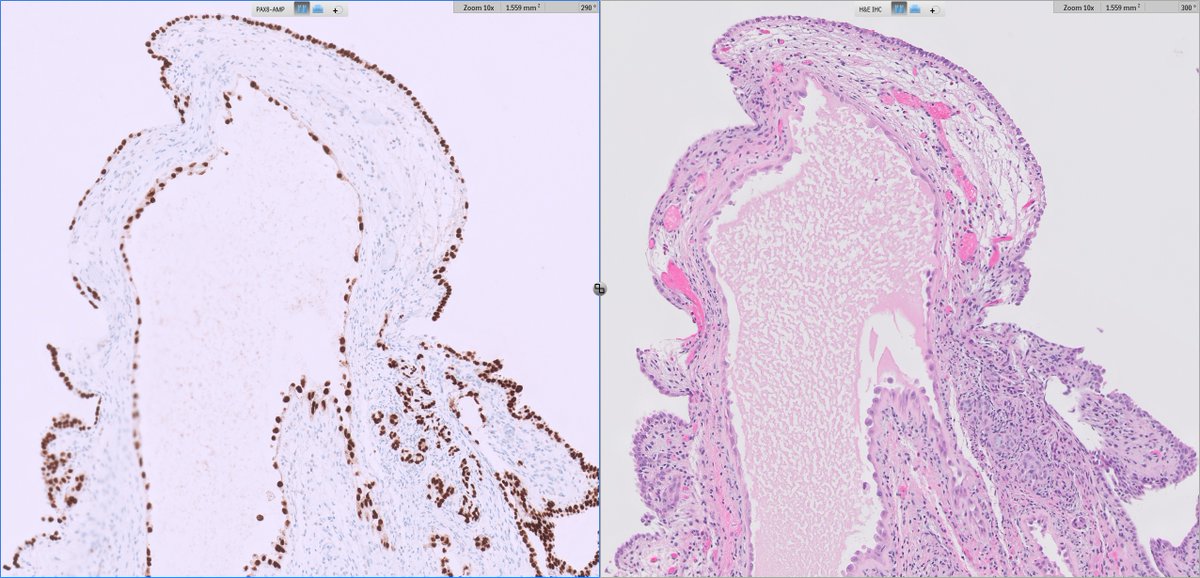 slusagar's tweet photo. #GUpath TURBT:

yes, typical tubular/cystic elements of nephrogenic adenoma (🥱)
but also...flat pattern NA😲 https://t.co/i9GZvKs63Y