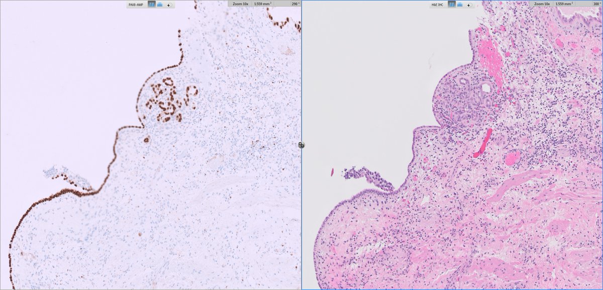 slusagar's tweet photo. #GUpath TURBT:

yes, typical tubular/cystic elements of nephrogenic adenoma (🥱)
but also...flat pattern NA😲 https://t.co/i9GZvKs63Y